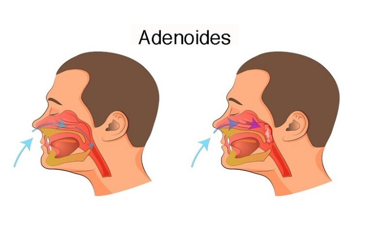 What are symptoms of adenoids problems? - Passion Life Love Health