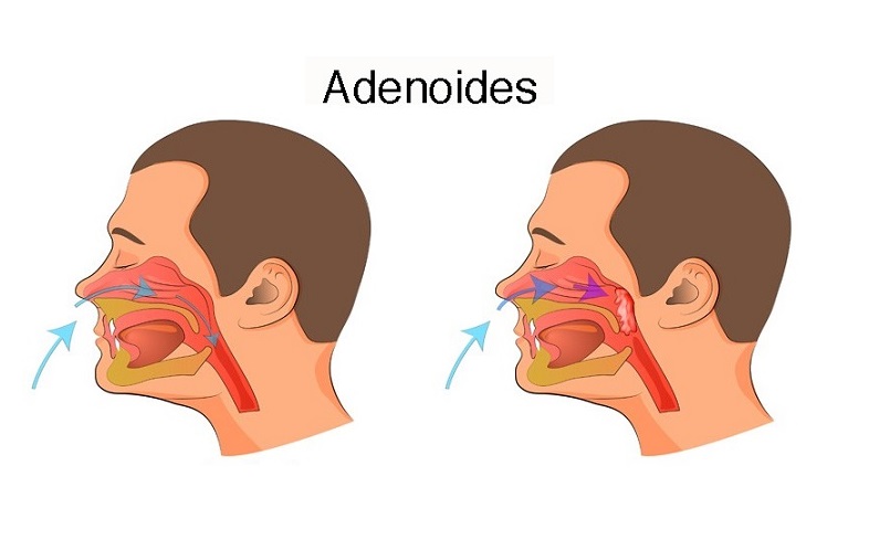 adenoids problems