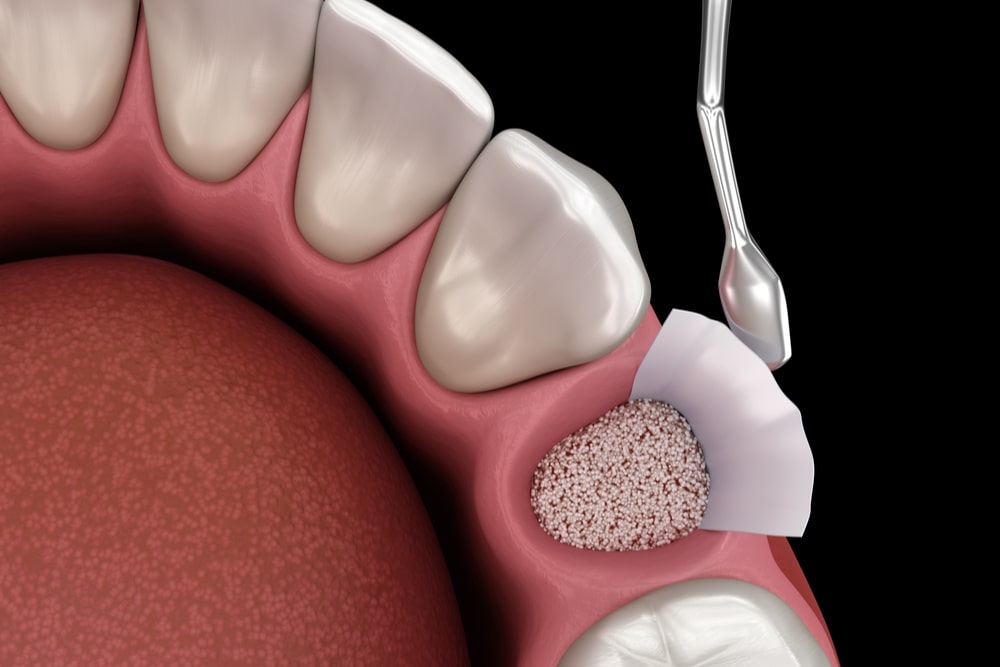 Get to Understand How Dental Bone Grafting Works Passion Life Love Health