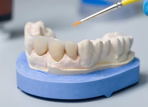 Dental Bridges