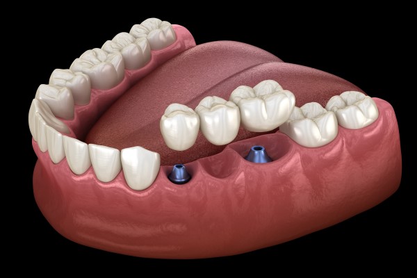 Dental Bridges