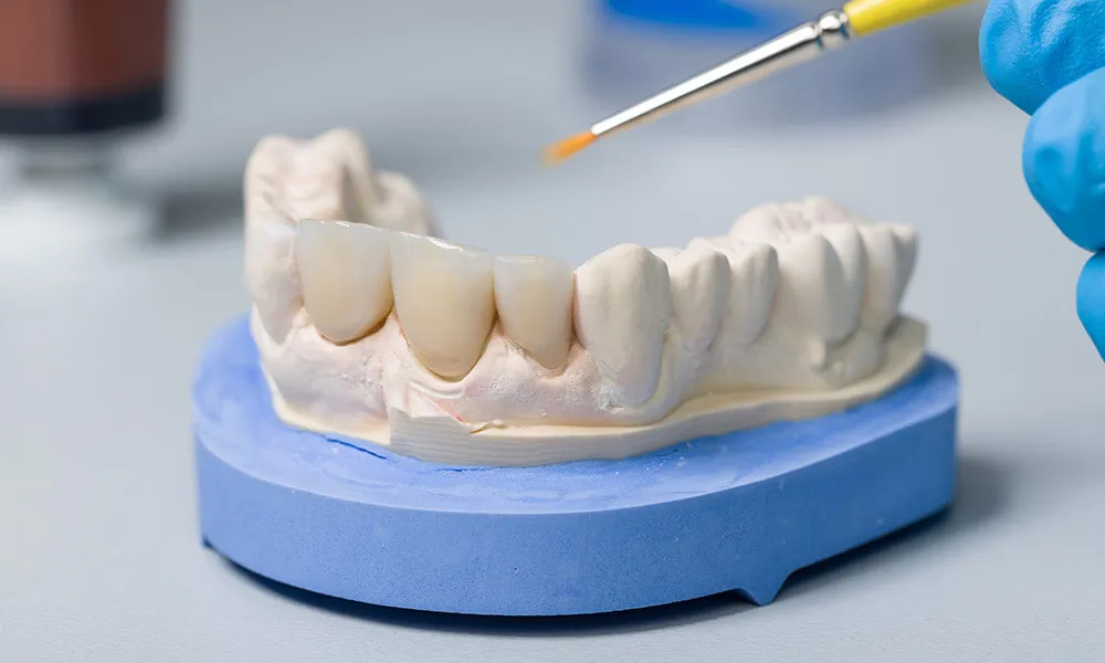 Dental Bridges