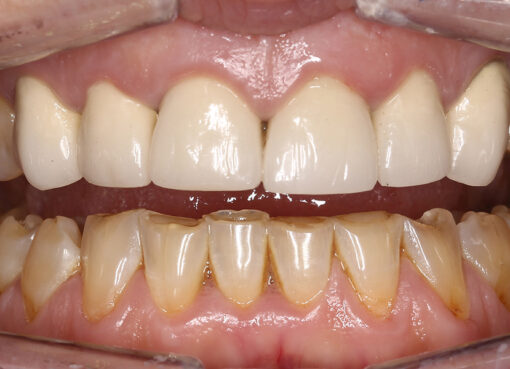 Dental Erosion