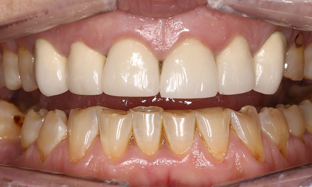 Dental Erosion