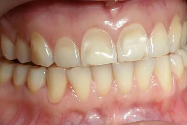 Dental Erosion