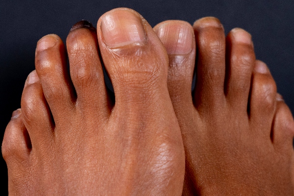 Hammer Toe