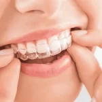 Invisalign for Teens