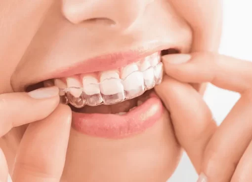 Invisalign for Teens