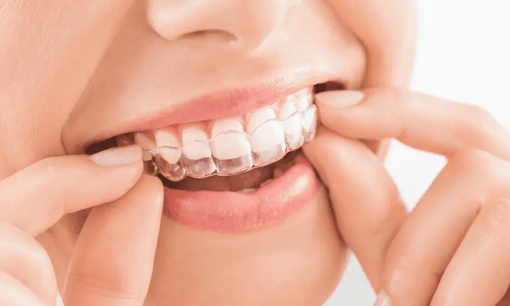 Invisalign for Teens