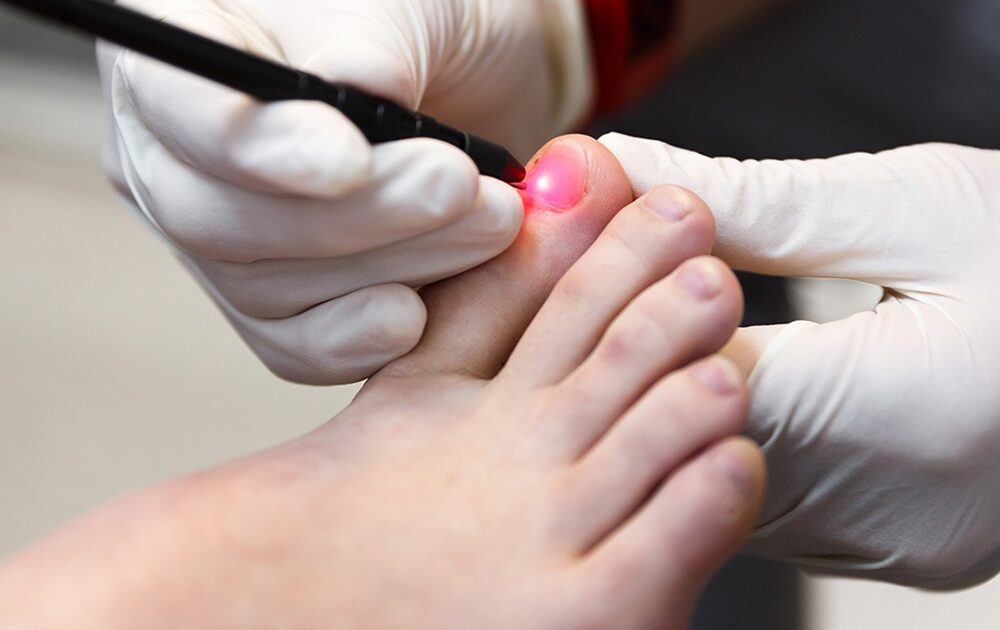Laser Therapy for Nail Disease