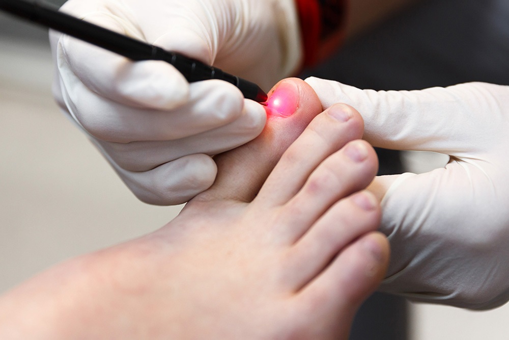 Laser Therapy for Nail Disease